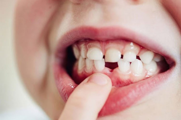 dientes de bebé