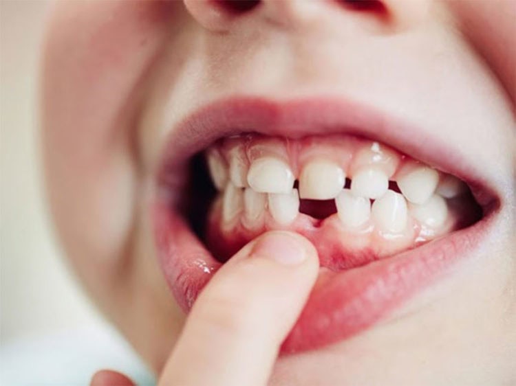 dientes de bebé