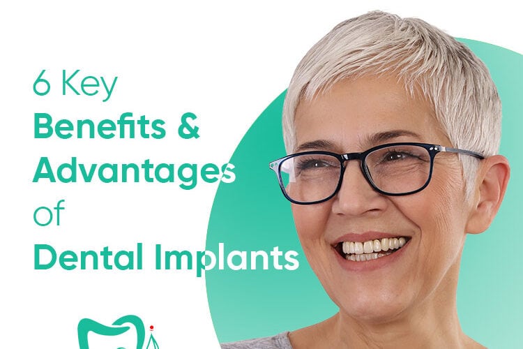 implantes dentales ventajas - dentista santa maria mai dental