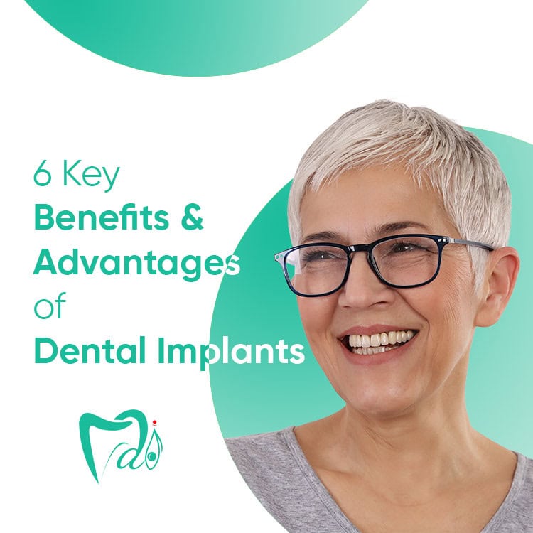 implantes dentales ventajas - dentista santa maria mai dental