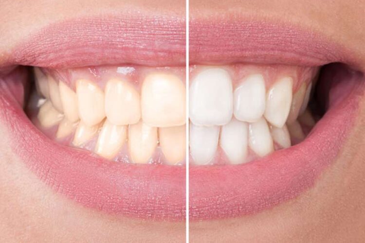 teeth_whitening_dentist_santa_maria