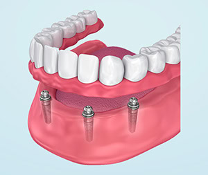 illustration of a Dental Implant Supported Denture