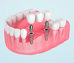 Illustration of fixed dental bridge teeth supported by two dental implants