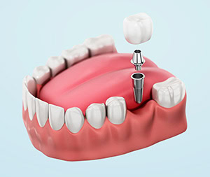 Illustration of a dental implant replacing a missing natural tooth