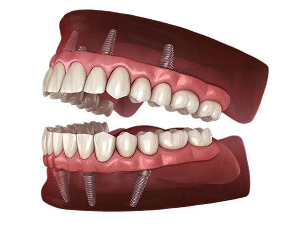 Illustration of fixed full-arch teeth supported by multiple dental implants