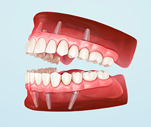 Illustration of fixed full-arch teeth supported by multiple dental implants