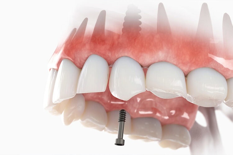Dental implant restoration showing an artificial tooth supported by an implant