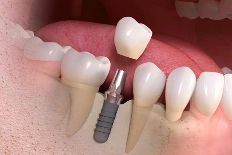 Single-tooth dental implant with crown, abutment, and implant post
