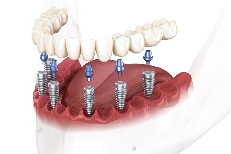 Illustration of fixed full-arch teeth supported by multiple dental implants