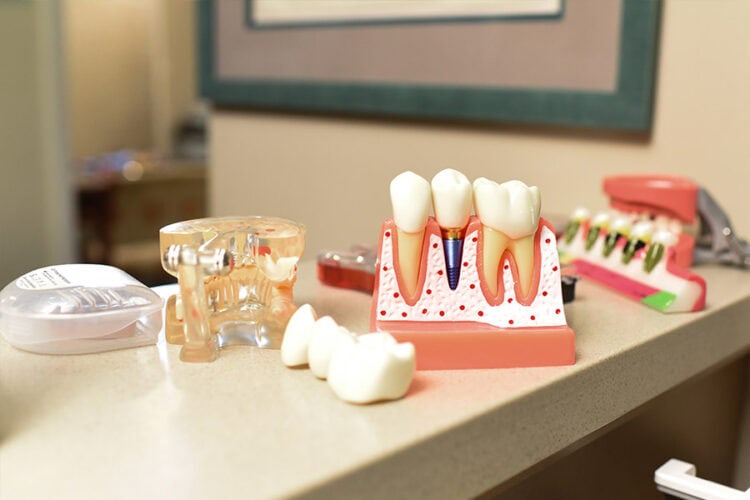 Dental implant restoration showing an artificial tooth supported by an implant