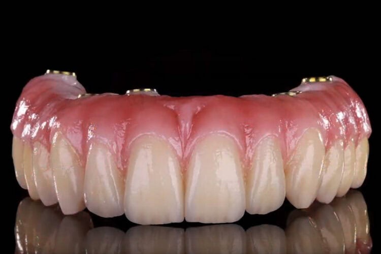 Implant-supported full-arch zirconia bridge used to restore missing teeth